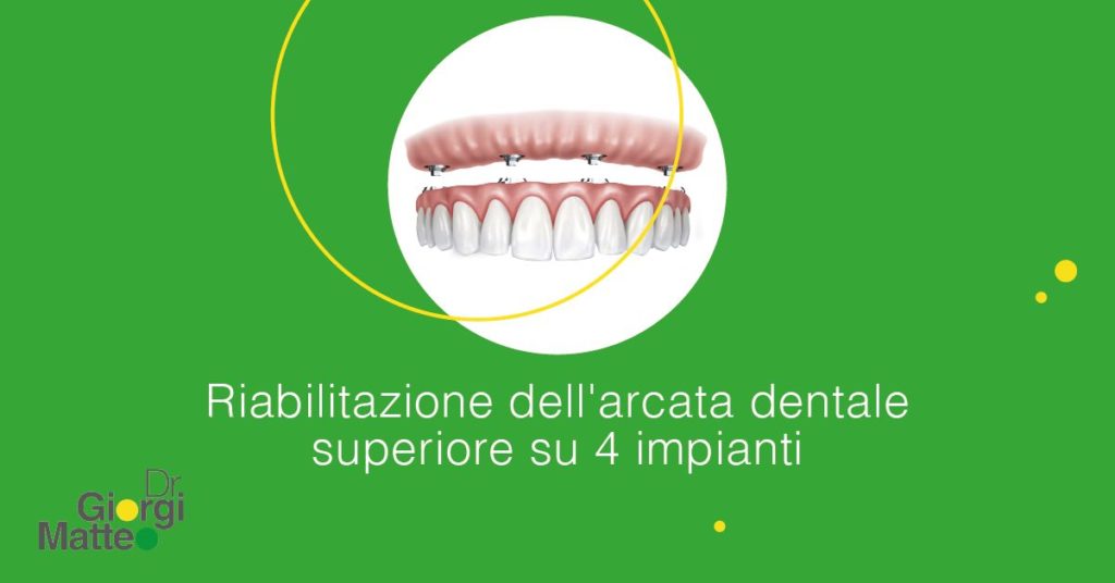 Riabilitazione dell'arcata dentale superiore su 4 impianti | Dr. Giorgi Matteo | Implantologia no limits