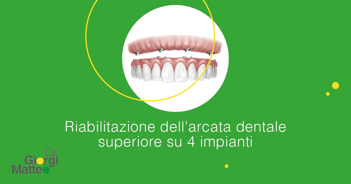 Riabilitazione dell'arcata dentale superiore su 4 impianti | Dr. Giorgi Matteo | Implantologia no limits