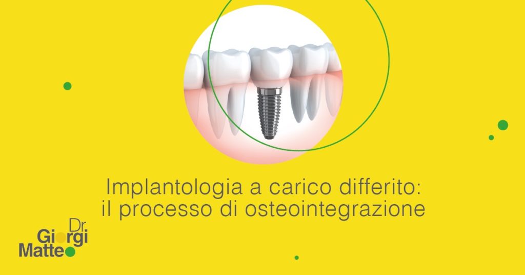 implantologia a carico differito | Dr. Giorgi Matteo | Implantologia no limits