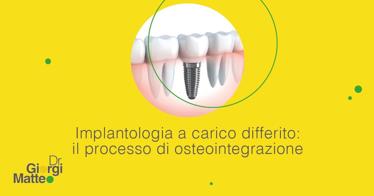 implantologia a carico differito | Dr. Giorgi Matteo | Implantologia no limits