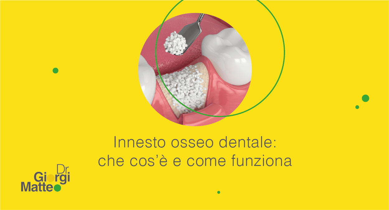innesto osseo dentale