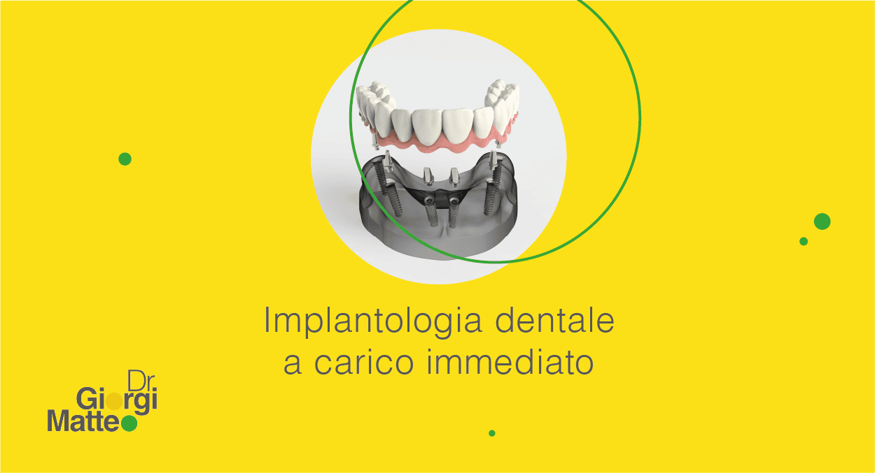 Implantologia dentale a carico immediato
